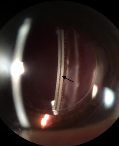 Artificial intraocular lens in the posterior chamber - dioptric power -3dpt